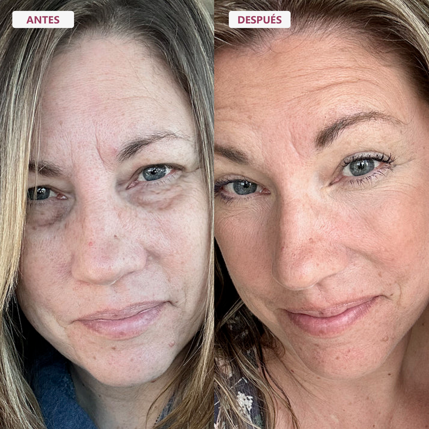 RE-ESTRUCTURA 45+® | El Rescate De La Firmeza Facial