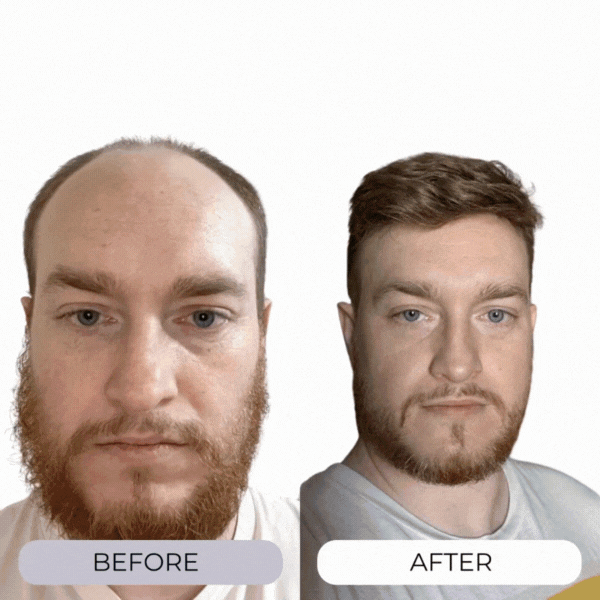 MICRO-INFUSE® | Tecnología capilar para hombres